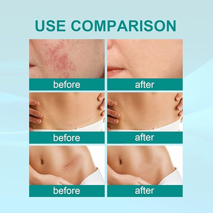 Medical Scar Removal Spray for Effective Skin Repair - Habibay Mart