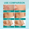 Medical Scar Removal Spray for Effective Skin Repair - Habibay Mart