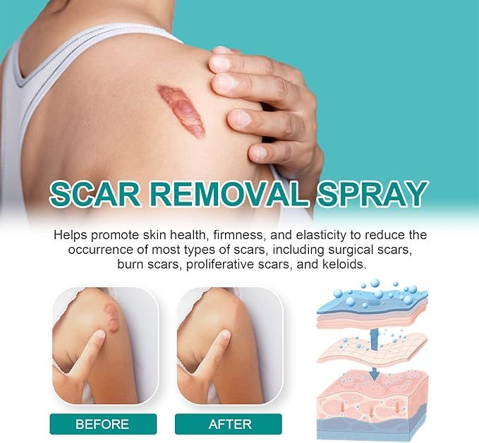 Medical Scar Removal Spray for Effective Skin Repair - Habibay Mart